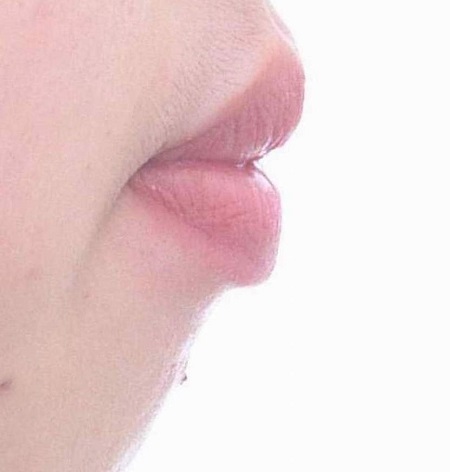 돌출입교정을 망하게 하는 이유! 관련 이미지 9
