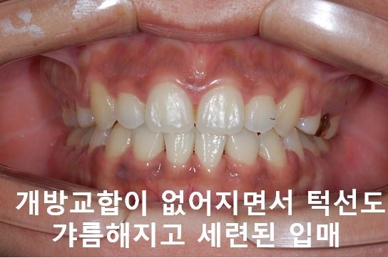 덧니교정이 곧 입매교정! 관련 이미지 16