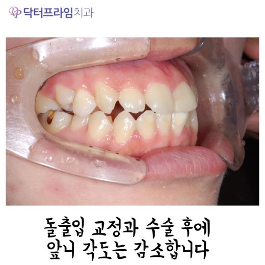 잇몸돌출교정 방법, 사진으로 보는 교정 방법! 관련 이미지 3