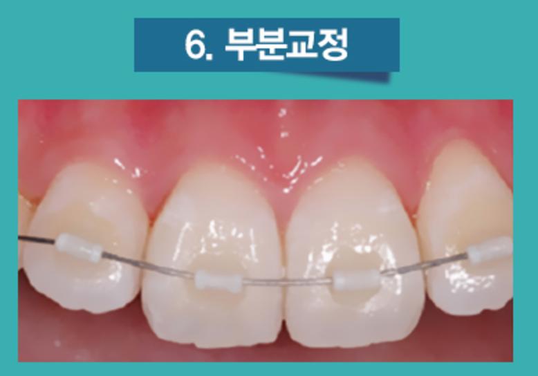 치아교정의 종류 4가지 1) 세라믹교정 2) 클리피시교정 3)설측교정 4) 투명교정 관련 이미지 6