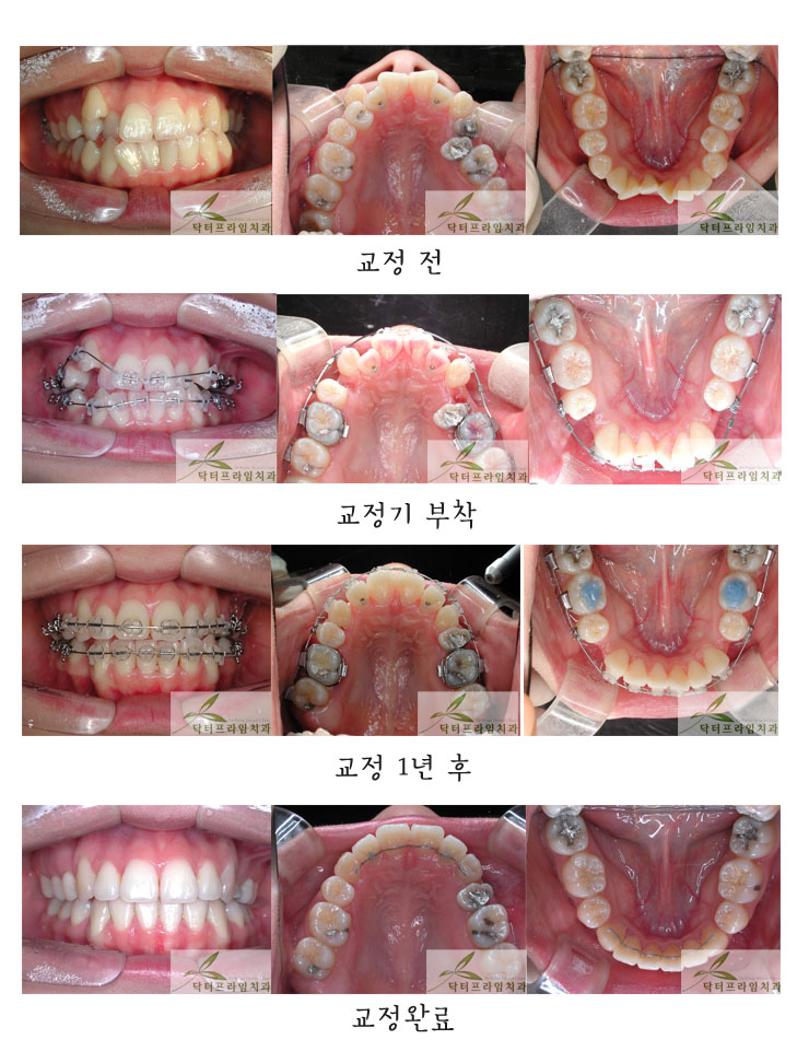 [치아교정후기] 덧니교정전후. 송곳니덧니 이대로 방치하면..!! 어떻게 될까요?! 관련 이미지 1