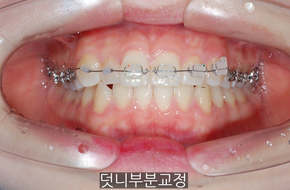 덧니부분교정하신 분들, 만족하시나요?? 관련 이미지 2