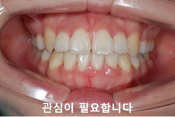 덧니교정 조심할것 3가지 관련 이미지 8