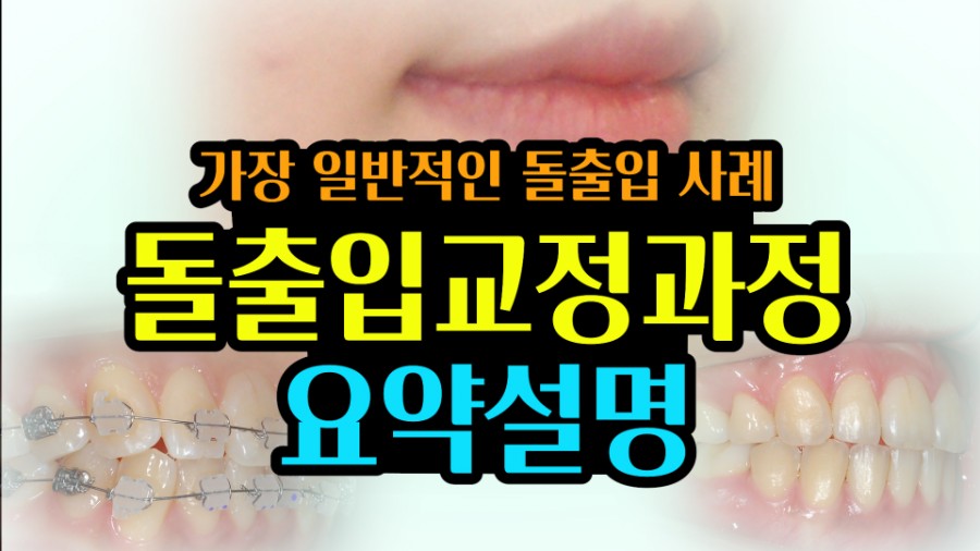 가장 일반적인 돌출입사례의 교정과정 요약설명! 관련 이미지 1