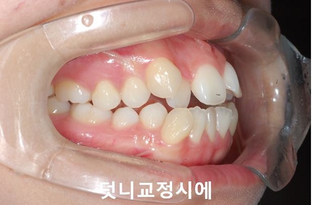 덧니교정 조심할것 3가지 관련 이미지 2