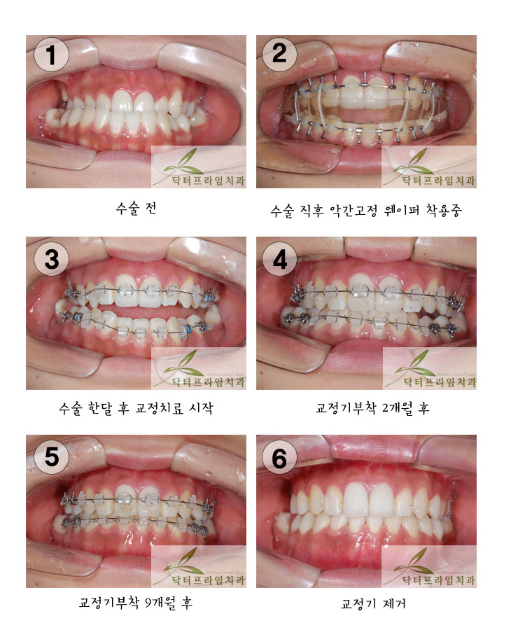[주걱턱교정] 주걱턱 양악선수술사례. 20대여성 관련 이미지 2