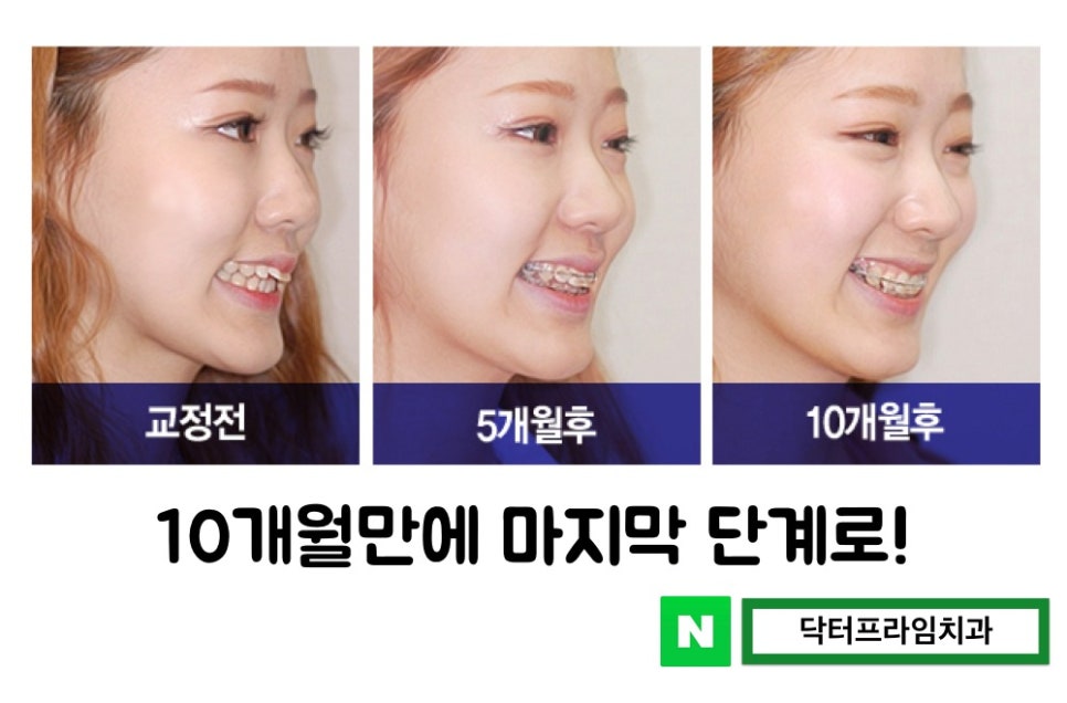 돌출입교정기간 짧은 기간에 가능하다! 관련 이미지 2