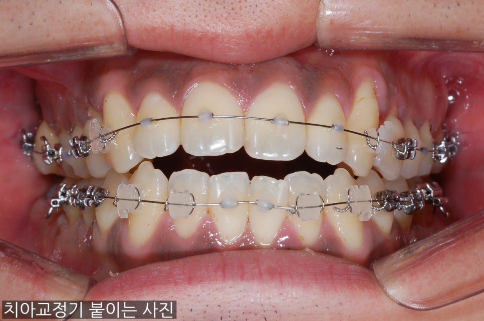 치아교정기 붙일때 환자가 알고 있어야 할 4가지~! 관련 이미지 4