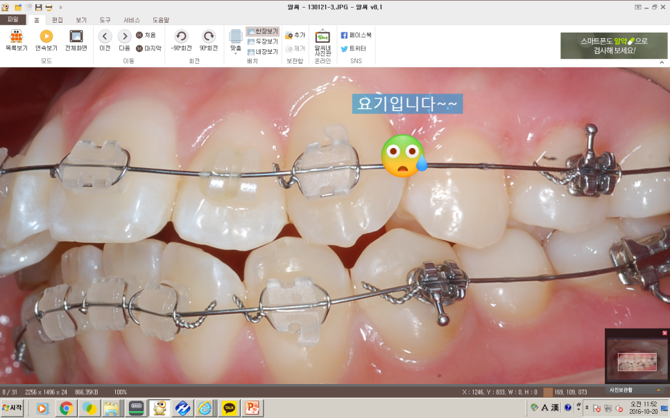 교정브라켓에 입술안쪽이 쓸려요 관련 이미지 2