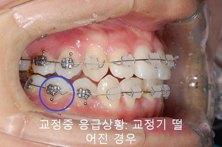 교정치과 잘 고르는 법! 먼 치과, 근처치과!! 관련 이미지 6