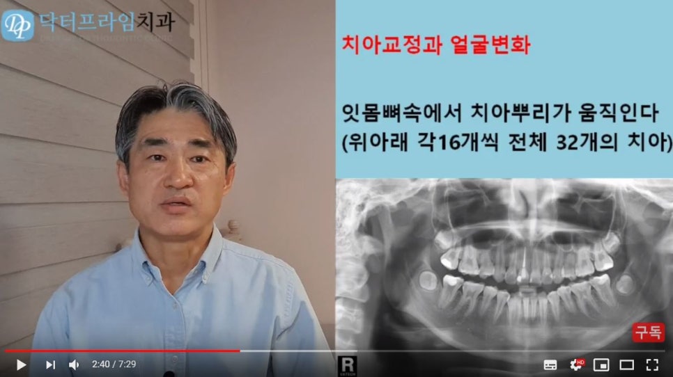 얼굴이 이뻐지는 치아교정! (덧니, 비대칭, 돌출입) 관련 이미지 4