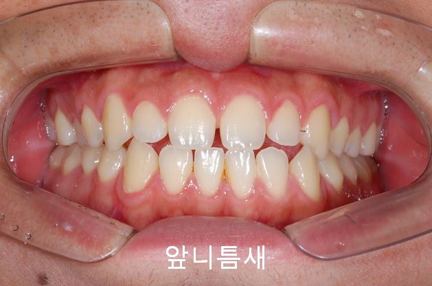 첫인상과 치아배열! 관련 이미지 2