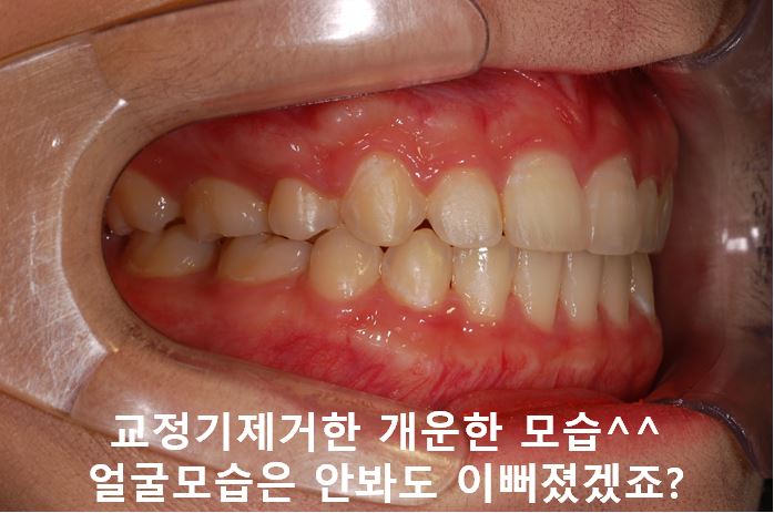 강남역돌출입교정, 옥니방지비법!! 관련 이미지 8