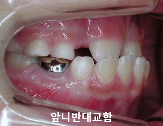 초등학생 앞니반대교합의 교정시기 안놓치는 법! 관련 이미지 3
