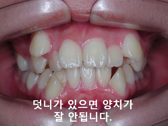 청소년, 덧니교정 안하면 이렇게 된다! 관련 이미지 1