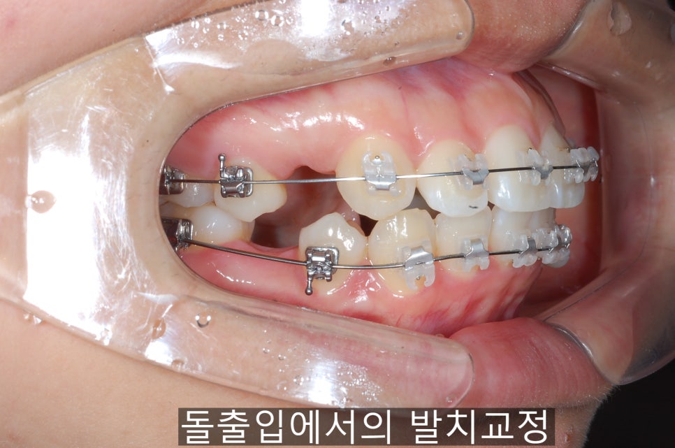 치아교정기간 짧아지는 방법 6가지! 관련 이미지 10
