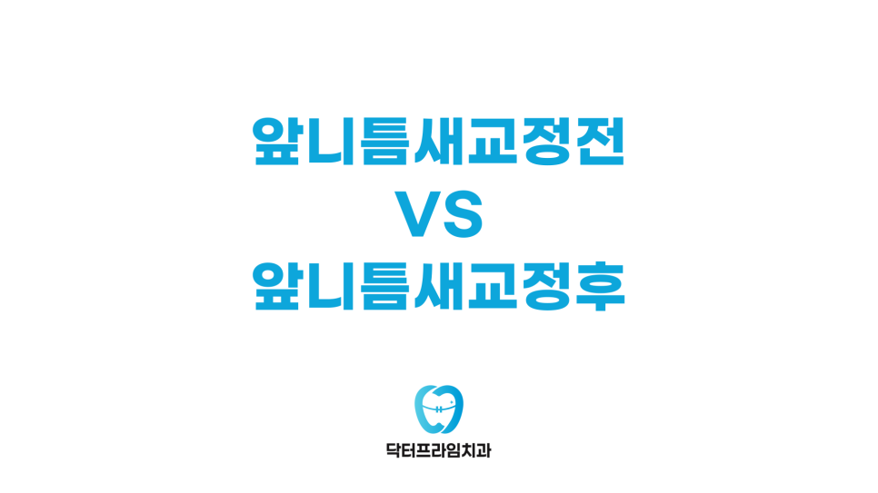 웃을 때 자꾸 입을 가려요 앞니 틈새 그냥 두면 안 되는 이유 관련 이미지 2
