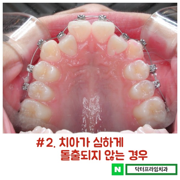 치아교정 발치 어떤 치아를 뺄 것인가? 관련 이미지 3