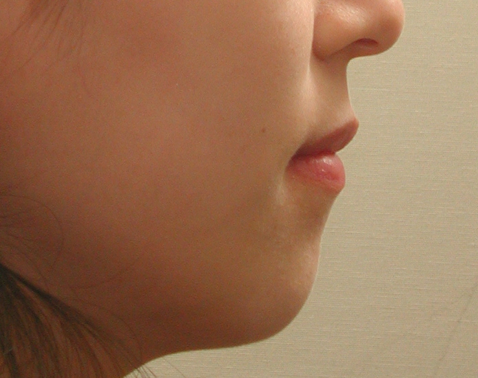 돌출입교정사례(전후사진) 관련 이미지 2