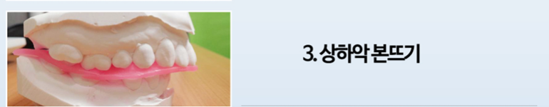 [치아교정] 교정정밀검사할때 왜 위아래치아 본뜨는 것일까요?? 관련 이미지 1