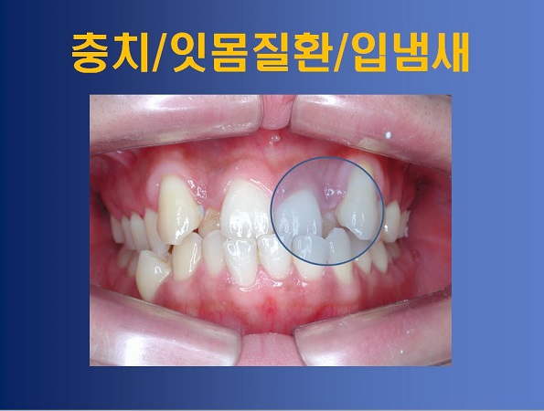 성장기 부정교합 방치했을때의 부작용! 관련 이미지 2