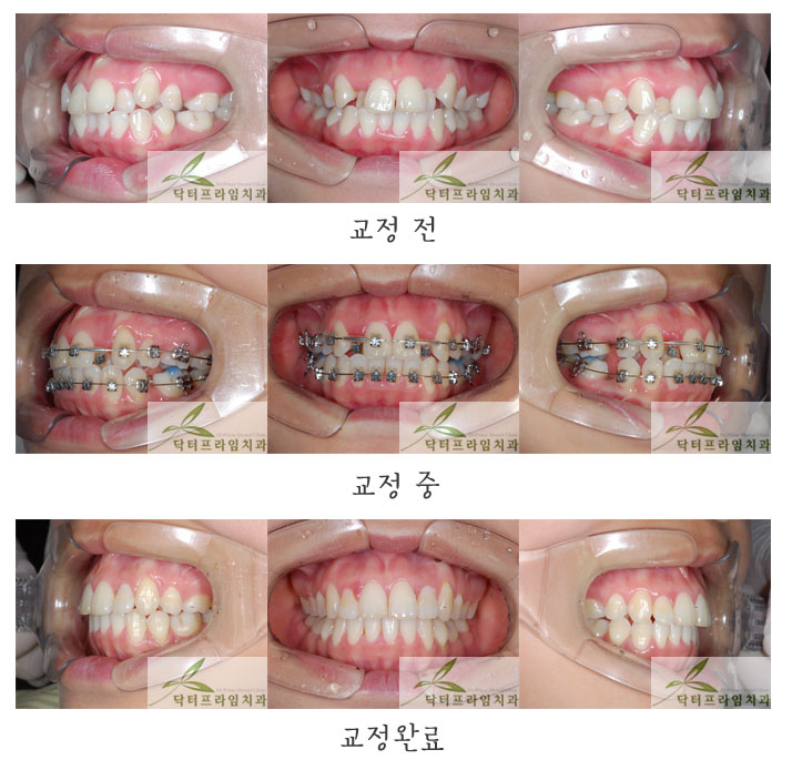 [치아교정후기] 덧니와 삐뚤빼뚤한 앞니교정! 관련 이미지 1