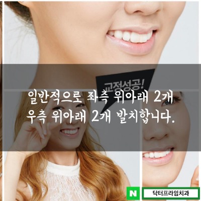 돌출입 교정 중 발치교정 과정 알아보기! 관련 이미지 2