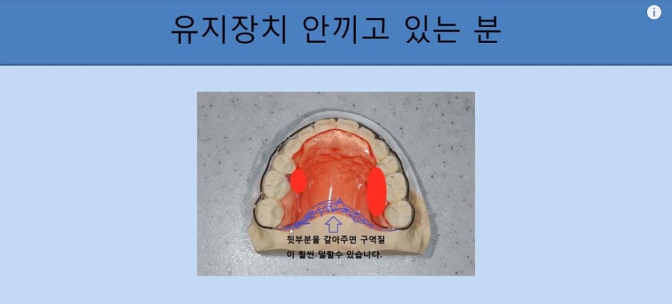 [치아교정] 치아교정 끝나고 요새 유지장치 안끼시는 분들 꼭 보시고 새출발하세요~~!! (돌출입교정, 덧니교정, 양악수술교정, 앞니교정한 분들 모두 해당됩니다) 관련 이미지 11