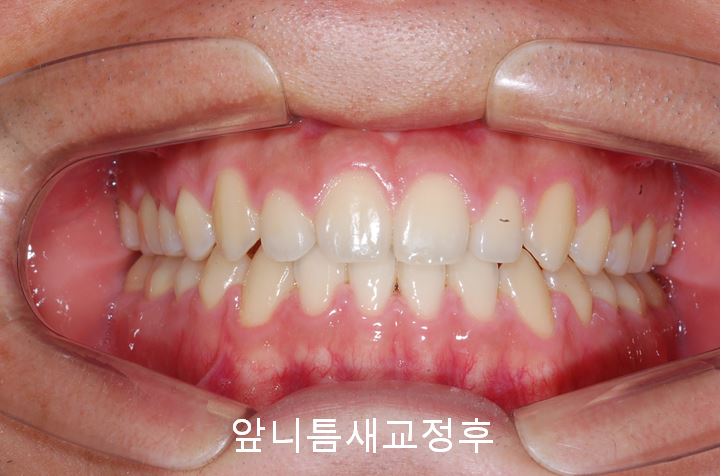 첫인상과 치아배열! 관련 이미지 7