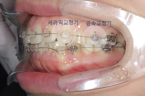 치아교정기의 구성요소(교정기, 교정철사, 미니스크류, 교정고무줄) 관련 이미지 1