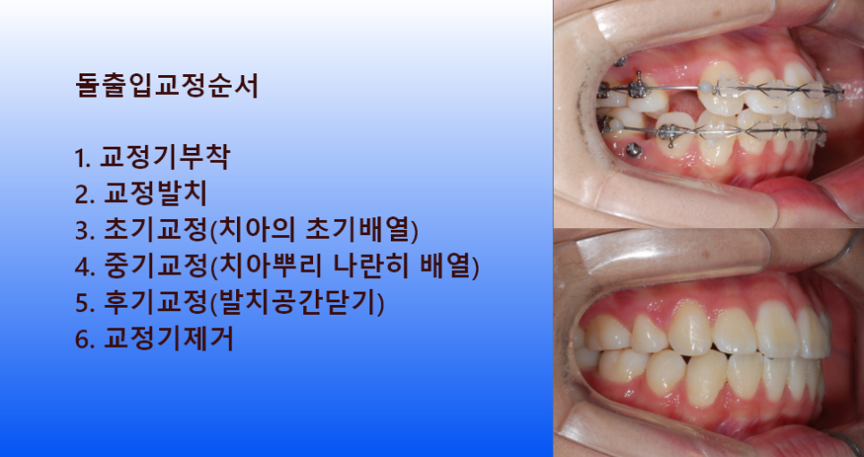 [치아교정] 돌출입교정순서를 단계별로 설명드릴께요! 관련 이미지 1