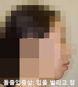 돌출입교정에 성공하는 방법 3가지! 관련 이미지 4