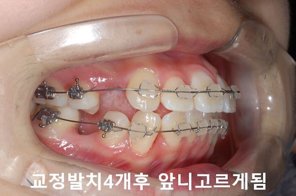 튀어나온입 교정과정 4단계요약 관련 이미지 4