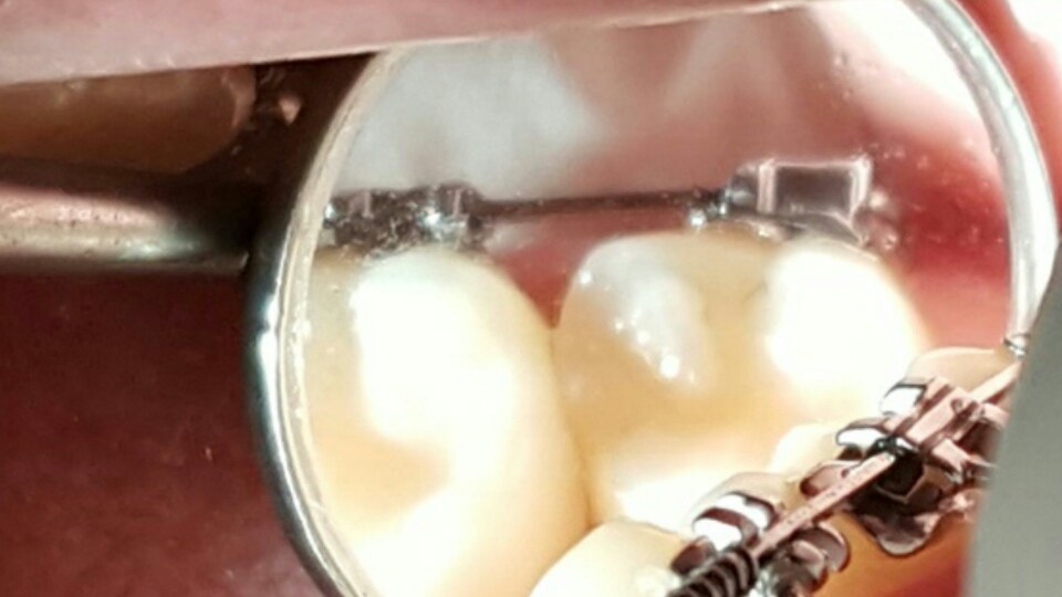 [치아교정] 교정철사변형, 알고 계신가요? 관련 이미지 1