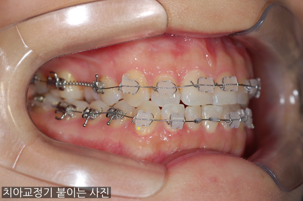 치아교정기 붙일때 환자가 알고 있어야 할 4가지~! 관련 이미지 1