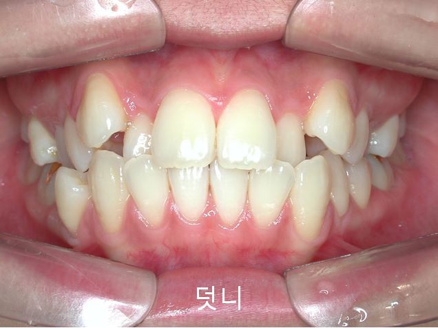 첫인상과 치아배열! 관련 이미지 1