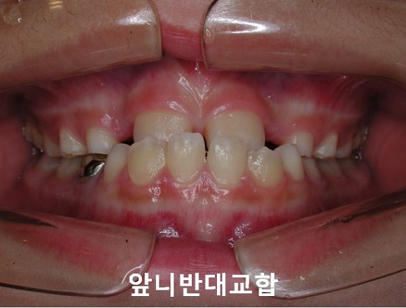 초등학생 앞니반대교합의 교정시기 안놓치는 법! 관련 이미지 2