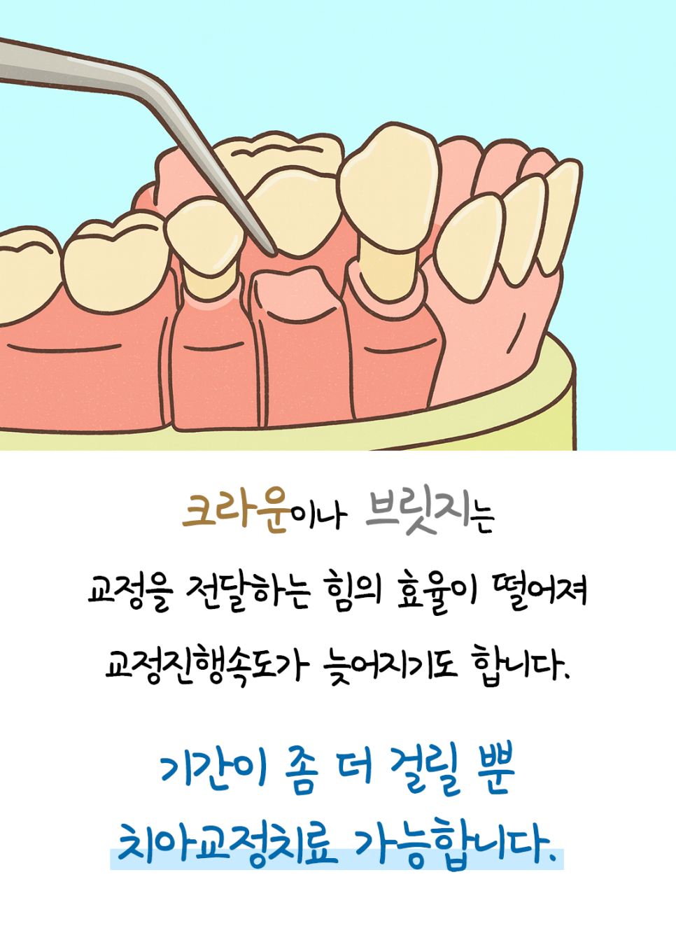 지르코니아, 골드크라운, 브릿지가 있어도 교정 가능한가요? &ndash; 주의할 점과 교정 후 관리까지 관련 이미지 3
