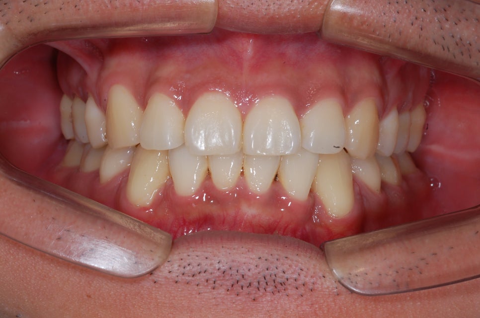 [남자돌출입교정전후] 남자돌출입교정의 진행과정 궁금하시죠?? 관련 이미지 5
