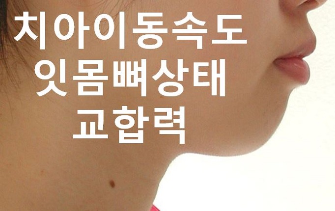 돌출입교정의 효과적인 시기! 관련 이미지 11