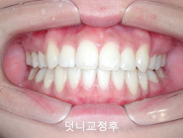 첫인상과 치아배열! 관련 이미지 5