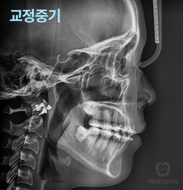 강남역 교정치과, 돌출입 발치교정하면 합죽해진다? 그렇습니다. 사실입니다 관련 이미지 13