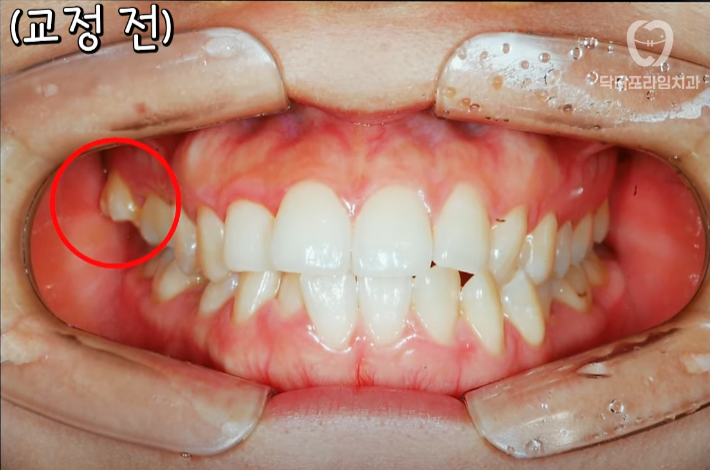 Facial asymmetry turns out to be caused by tooth alignment—can be improved with orthodontics! image 6