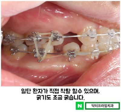 치아교정 고무줄 기능 그리고 모양 관련 이미지 2