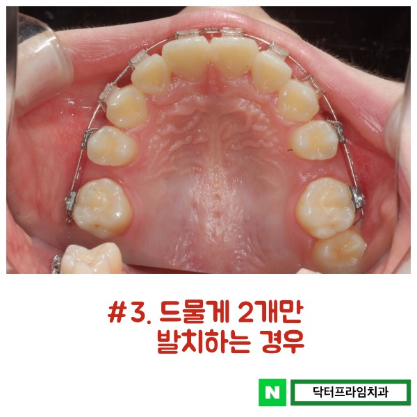 치아교정 발치 어떤 치아를 뺄 것인가? 관련 이미지 4