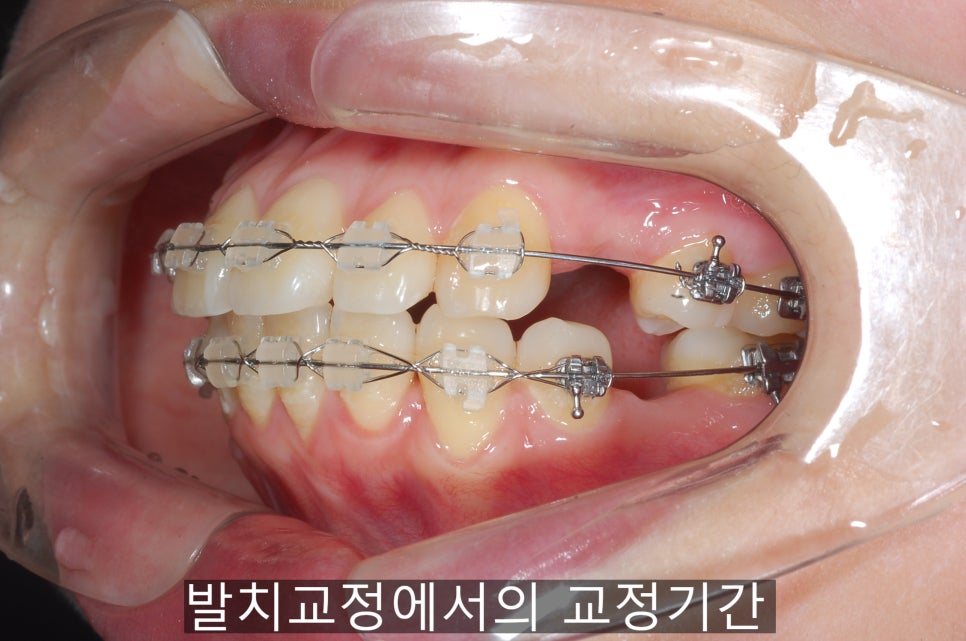 치아교정기간 짧아지는 방법 6가지! 관련 이미지 7