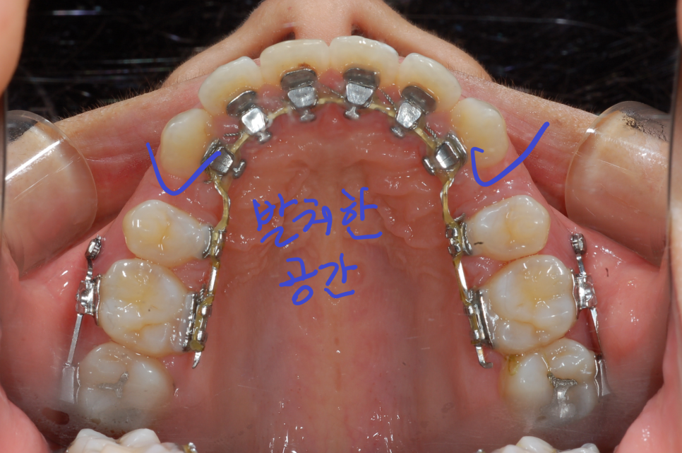[치아교정] 돌출입이나 덧니교정시 작은어금니발치와 사랑니발치순서! (작은어금니와 사랑니까지 한꺼번에 너무 많이 뽑으면 힘들어요!!) 관련 이미지 1