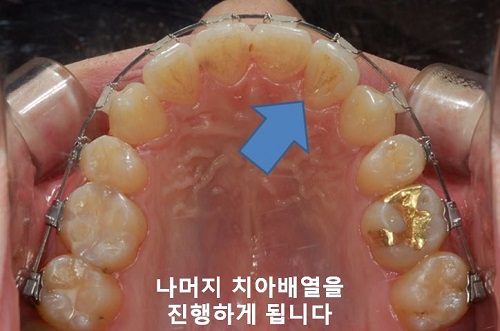 덧니교정과정, 4가지 요점만 알고 시작하세요! 관련 이미지 15