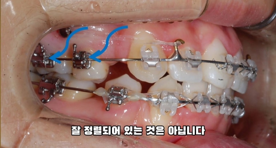 돌출입 교정 하실 분, 이것만은 꼭 알고 시작해야 합니다! 관련 이미지 6