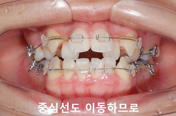 덧니교정 조심할것 3가지 관련 이미지 6
